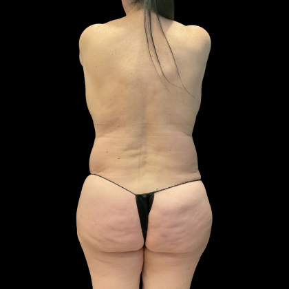 Tummy Tuck Before & After Patient #13664