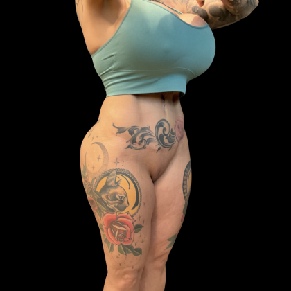 Butt Implants Before & After Patient #13659