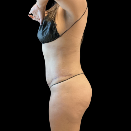 Tummy Tuck Before & After Patient #13666
