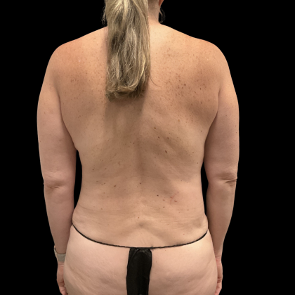 Tummy Tuck Before & After Patient #13672