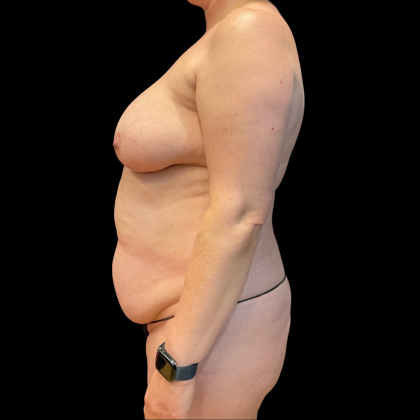 Tummy Tuck Before & After Patient #13664