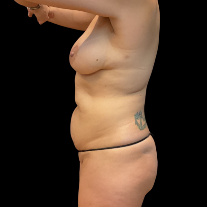 Mommy Makeover Before & After Patient #13665