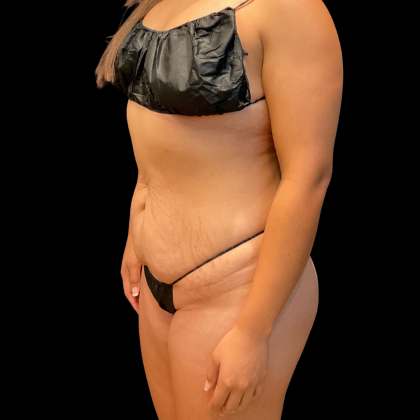 Tummy Tuck Before & After Patient #13666