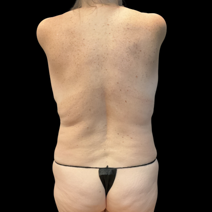 Tummy Tuck Before & After Patient #13672