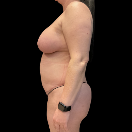 Tummy Tuck Before & After Patient #13664