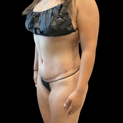 Tummy Tuck Before & After Patient #13666