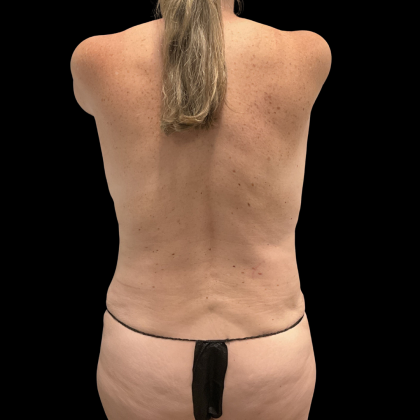 Tummy Tuck Before & After Patient #13672