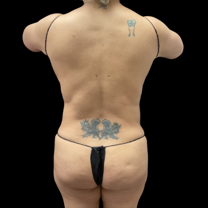 Liposuction Before & After Patient #13684