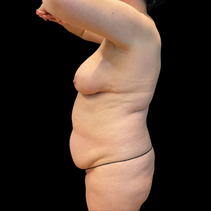 Tummy Tuck Before & After Patient #13664