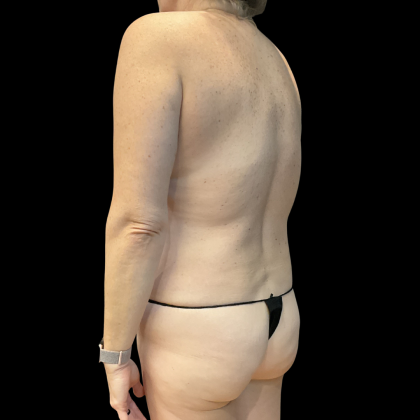 Tummy Tuck Before & After Patient #13672