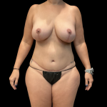 Mommy Makeover Before & After Patient #13589