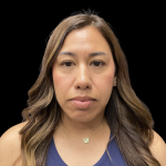 MyEllevate Before & After Patient #13663