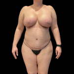 Tummy Tuck Before & After Patient #13664