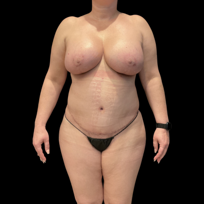 Tummy Tuck Before & After Patient #13664