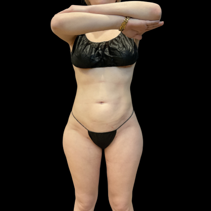 High Definition Liposuction Before & After Patient #13667