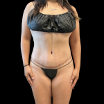 Tummy Tuck Before & After Patient #13666