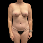 Tummy Tuck Before & After Patient #13672
