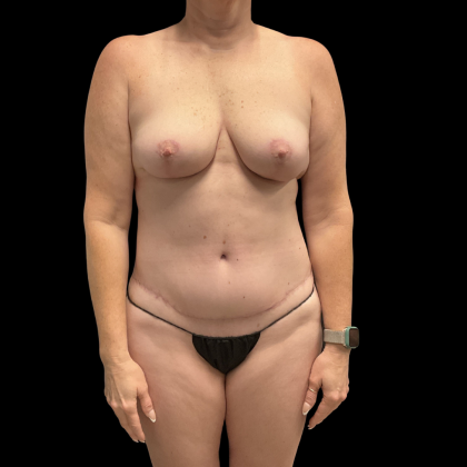 Tummy Tuck Before & After Patient #13672