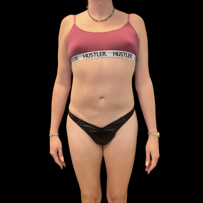 Rib Repositioning Before & After Patient #13675