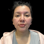 MyEllevate Before & After Patient #13624
