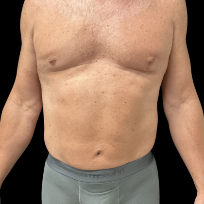 Liposuction Before & After Patient #13685
