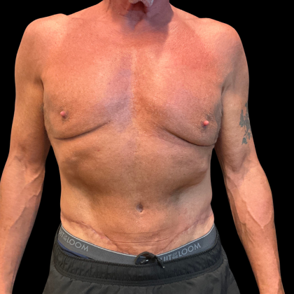 Tummy Tuck Before & After Patient #13683