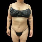 Liposuction Before & After Patient #13684
