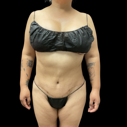 Liposuction Before & After Patient #13684