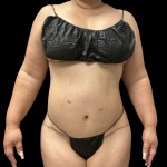 Brazilian Butt Lift Before & After Patient #13626