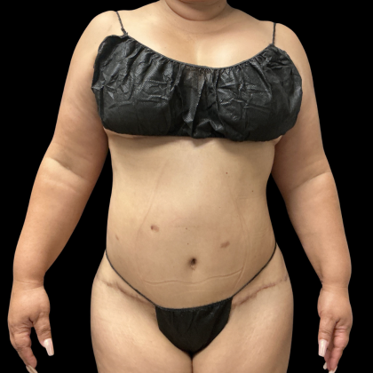 Brazilian Butt Lift Before & After Patient #13626
