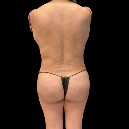 Brazilian Butt Lift Before & After Patient #13588
