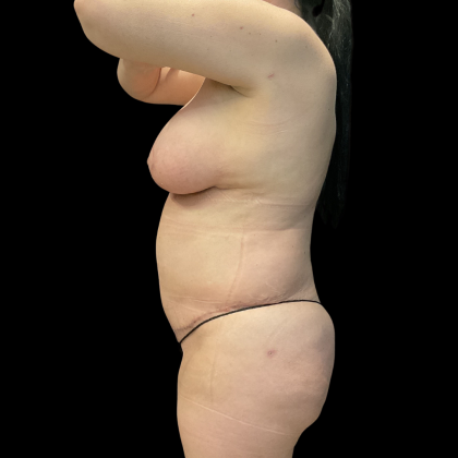 Tummy Tuck Before & After Patient #13664