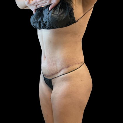 Tummy Tuck Before & After Patient #13666