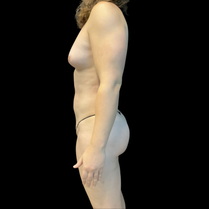 Fat Transfer Before & After Patient #13661