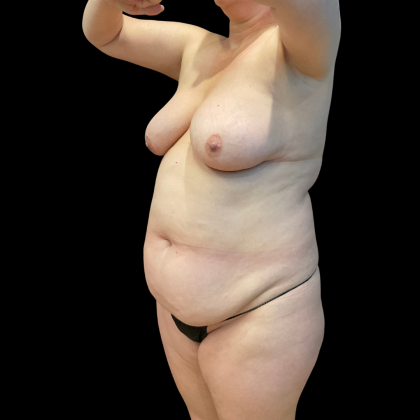 Tummy Tuck Before & After Patient #13664