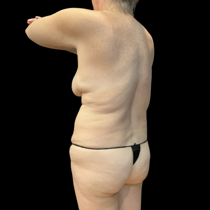 Tummy Tuck Before & After Patient #13672