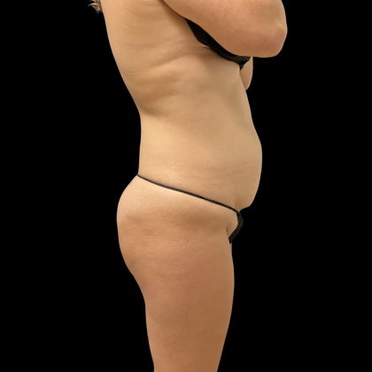 Fat Transfer Before & After Patient #13680
