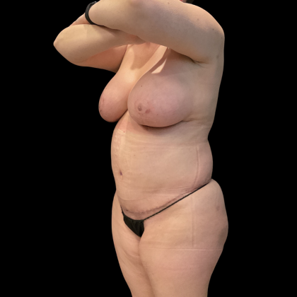 Tummy Tuck Before & After Patient #13664
