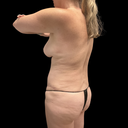 Tummy Tuck Before & After Patient #13672