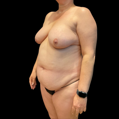 Tummy Tuck Before & After Patient #13664