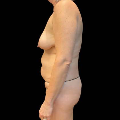 Tummy Tuck Before & After Patient #13672