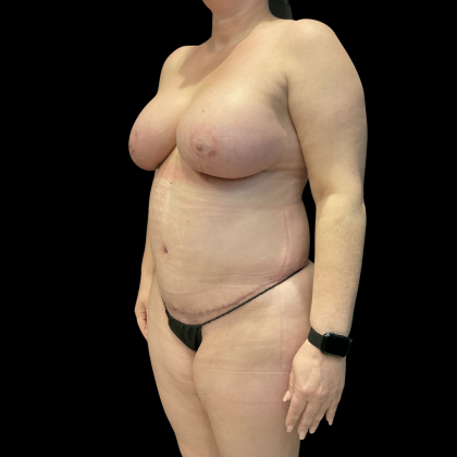 Tummy Tuck Before & After Patient #13664