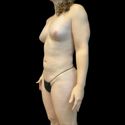 Fat Transfer Before & After Patient #13661