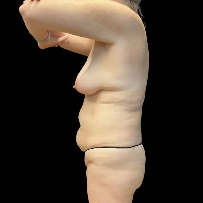 Tummy Tuck Before & After Patient #13672