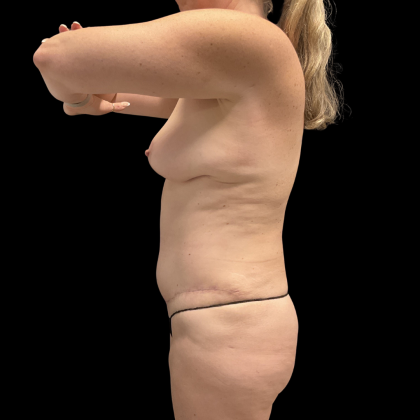 Tummy Tuck Before & After Patient #13672