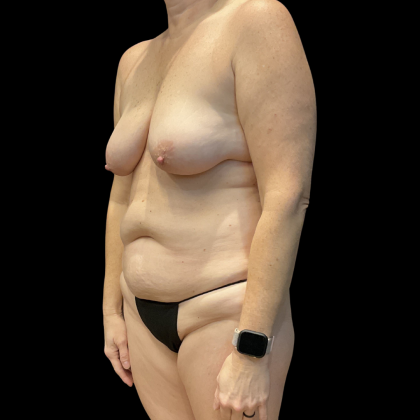 Tummy Tuck Before & After Patient #13672