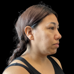 MyEllevate Before & After Patient #13663