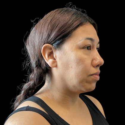 MyEllevate Before & After Patient #13663