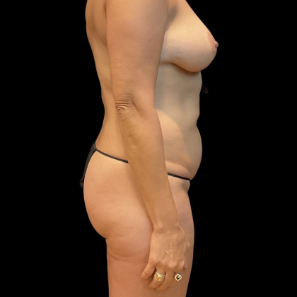 Mommy Makeover Before & After Patient #13665