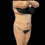 Brazilian Butt Lift Before & After Patient #13588